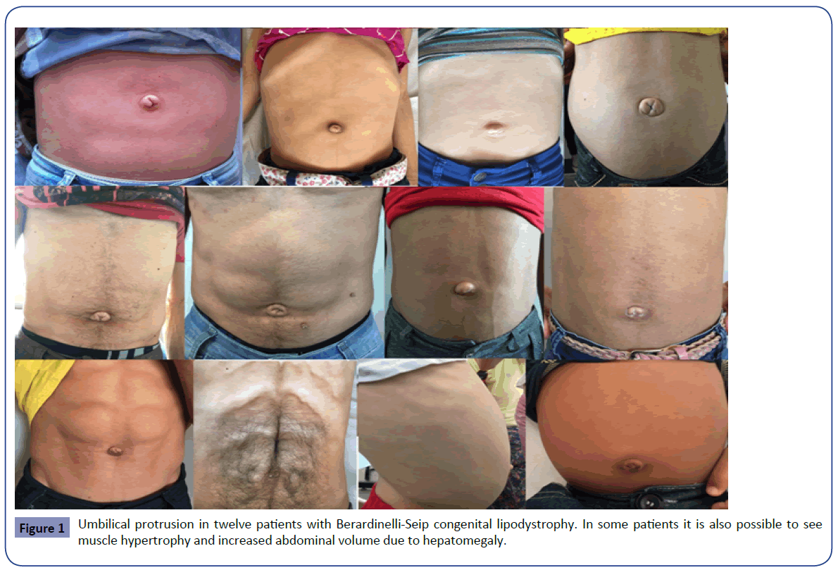 Umbilical Hernia in Patients with Berardinelliseip ...